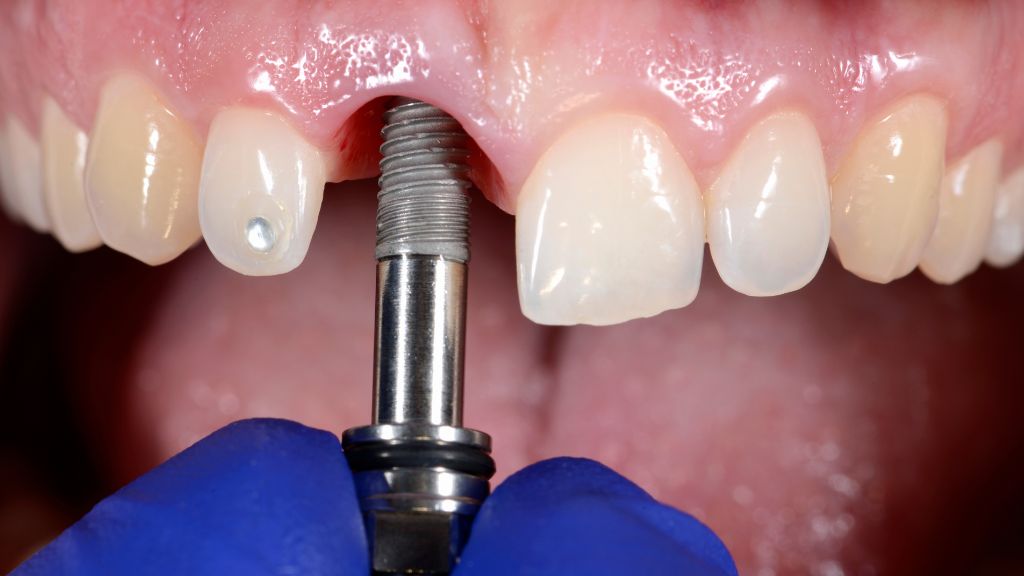 Are Dental Implants Permanent, or Just Built to Outlast You