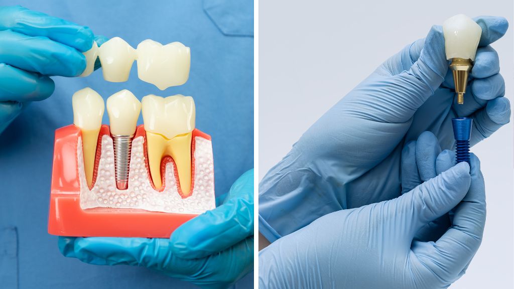 Single Tooth Replacement Bridge vs Implant-Supported Restoration: Which Lasts Longer