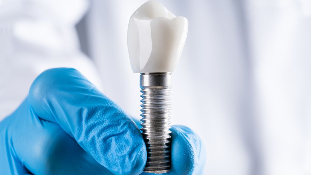 All-on-4 vs. Traditional Dental Implants: Key Differences Explained