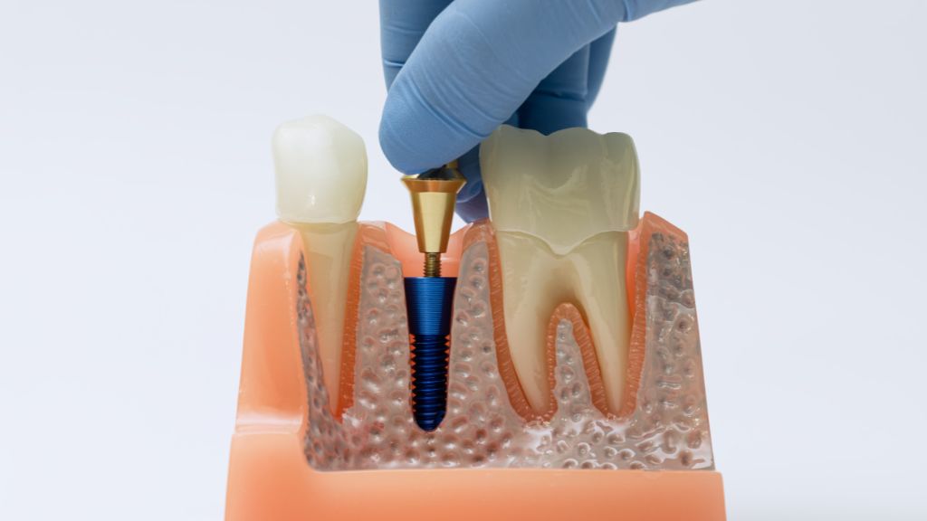 Bone Grafting Before Dental Implants: When Is It Needed?
