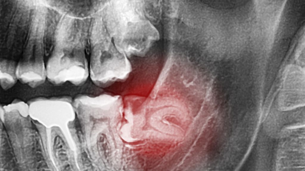 Impacted Wisdom Teeth: Signs You Should Not Ignore