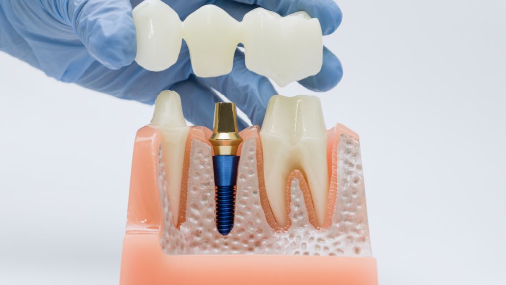 How Long Do Dental Implants Last Before Replacement?